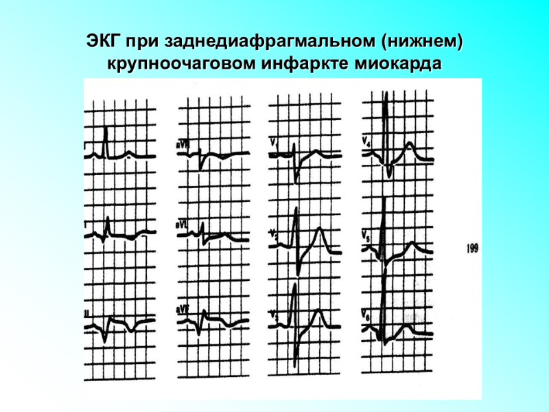 ЭКГ при заднедиафрагмальном (нижнем) крупноочаговом инфаркте миокарда